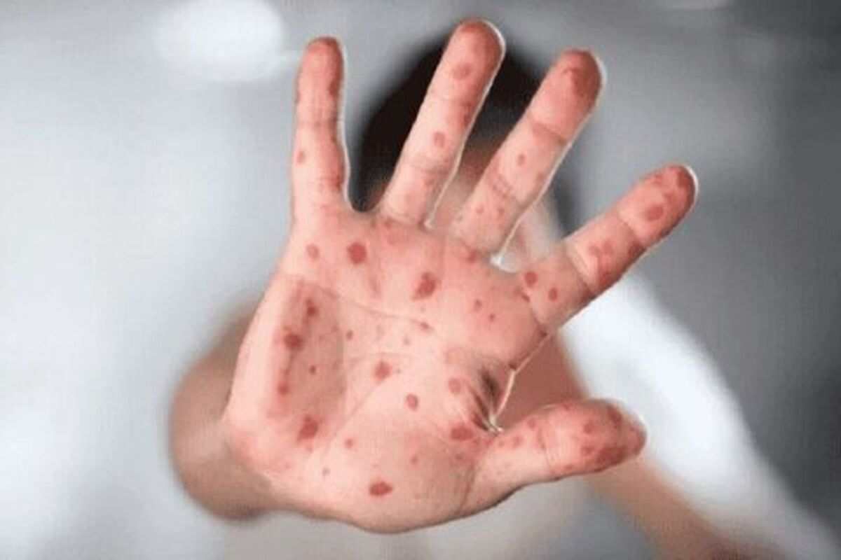 آبله میمون