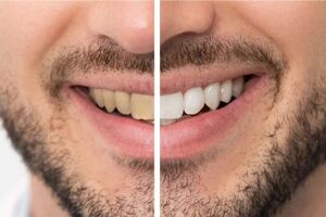 لمینت دندان، راه‌حل نهایی برای اصلاح لبخندهای زرد سیگاری‌ها!
