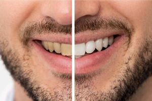 لمینت دندان، راه‌حل نهایی برای اصلاح لبخندهای زرد سیگاری‌ها!