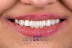 انواع لمینت دندان با قیمت مناسب