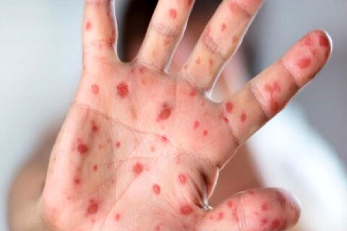 بیماری سرخک