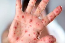 موردی از سرخک در خوزستانی‌ها و اتباع خارجی مشاهده نشده است