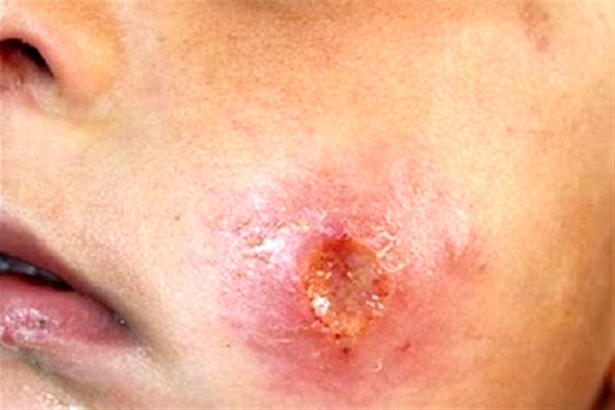 بیماری سالک