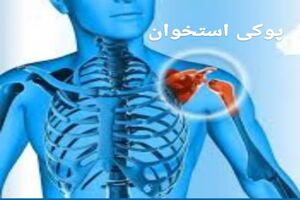 هشدار به مسئولان؛بیماری مهلک و خاموش پوکی استخوان را جدی بگیرید /ضرورت  غنی کردن مواد غذایی با کربنات کلسیم