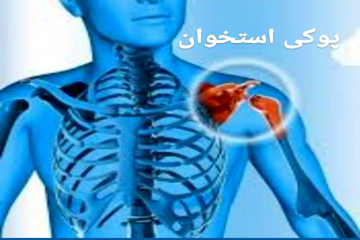 پوکی استخوان