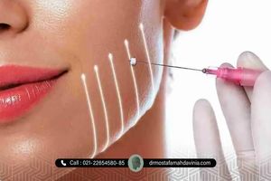 معرفی بهترین ناحیه ها برای لیفت با نخ