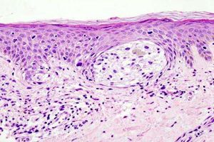 امید پزشکان به درمان سرطان ملانوم در آینده نزدیک