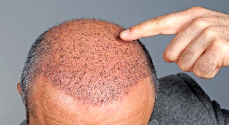 مزایا و معایب کاشت مو/ کاشت مو، بهترین راه درمان و ترمیم موهای از دست رفته!؟
