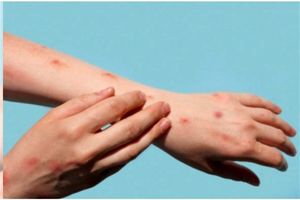 ضایعات پوستی آبله میمونی بیشتر در کدام قسمت های بدن ظاهر میشوند؟