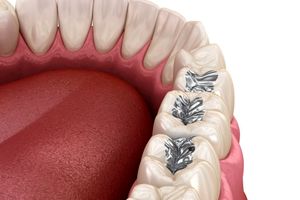 پر کردن دندان با مواد سفید یا سیاه؛ کدام گزینه مناسب‌تر است؟
