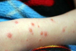 مصرف لبنیات محلی از عوامل شیوع تب مالت است