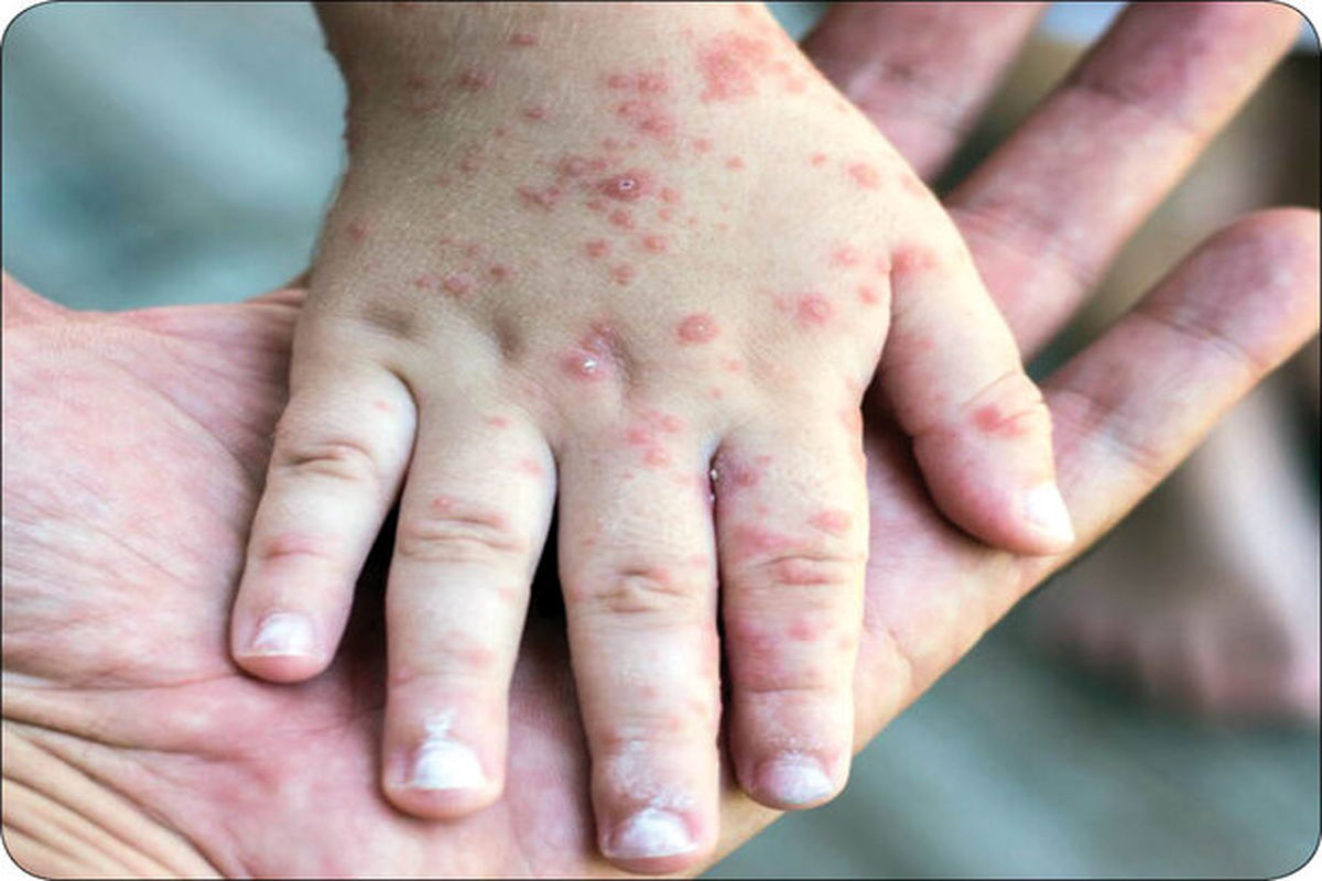 سرخک در هرمزگان 