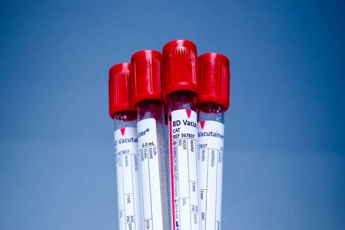 انجام آزمایش PBS