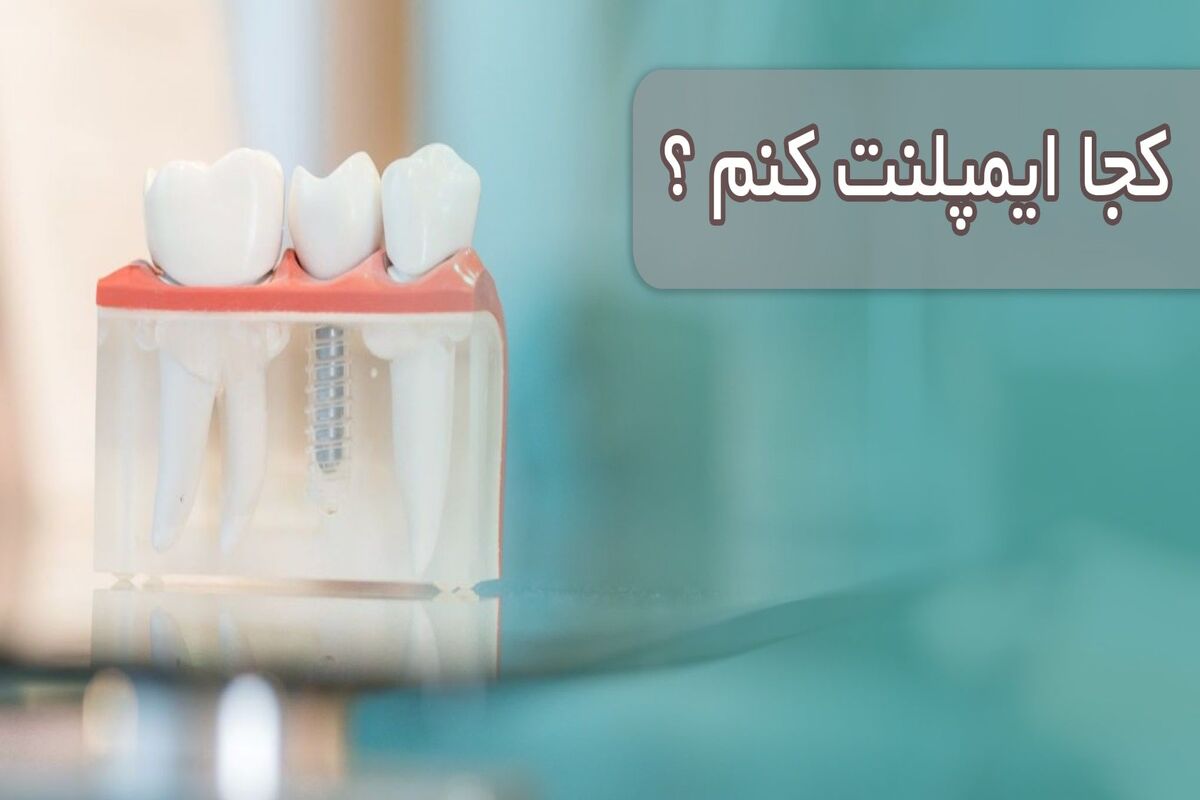 ایمپلنت
