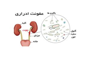 راه حل ساده برای جلوگیری از عفونت مجاری ادراری