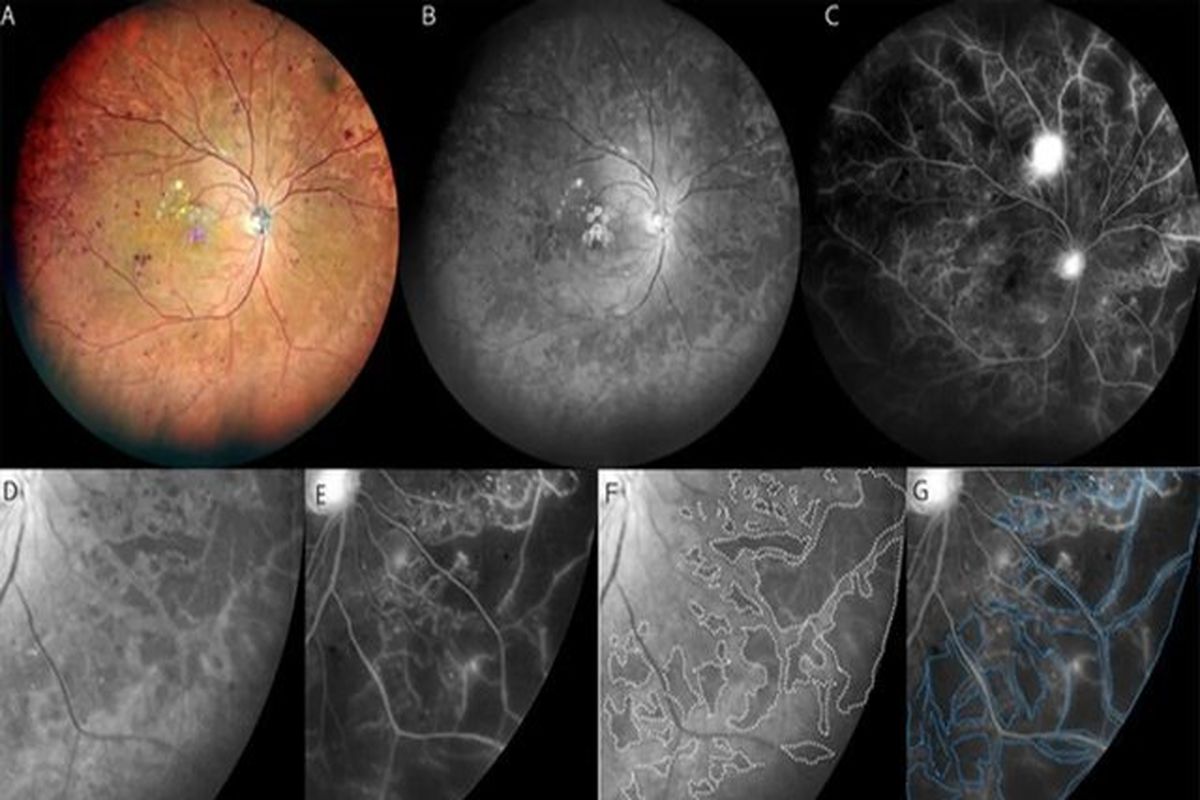رتینوپاتی دیابتی