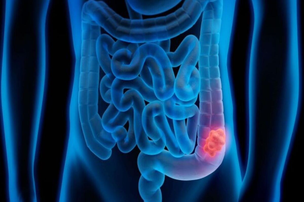 سرطان روده بزرگ_1