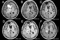 آغاز بزرگترین مطالعه بشر در زمینه سرطان مغز