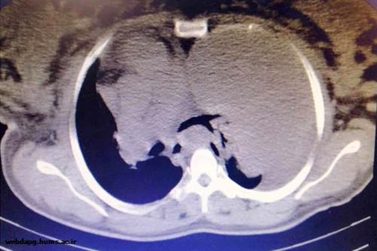تومور 2 کیلویی