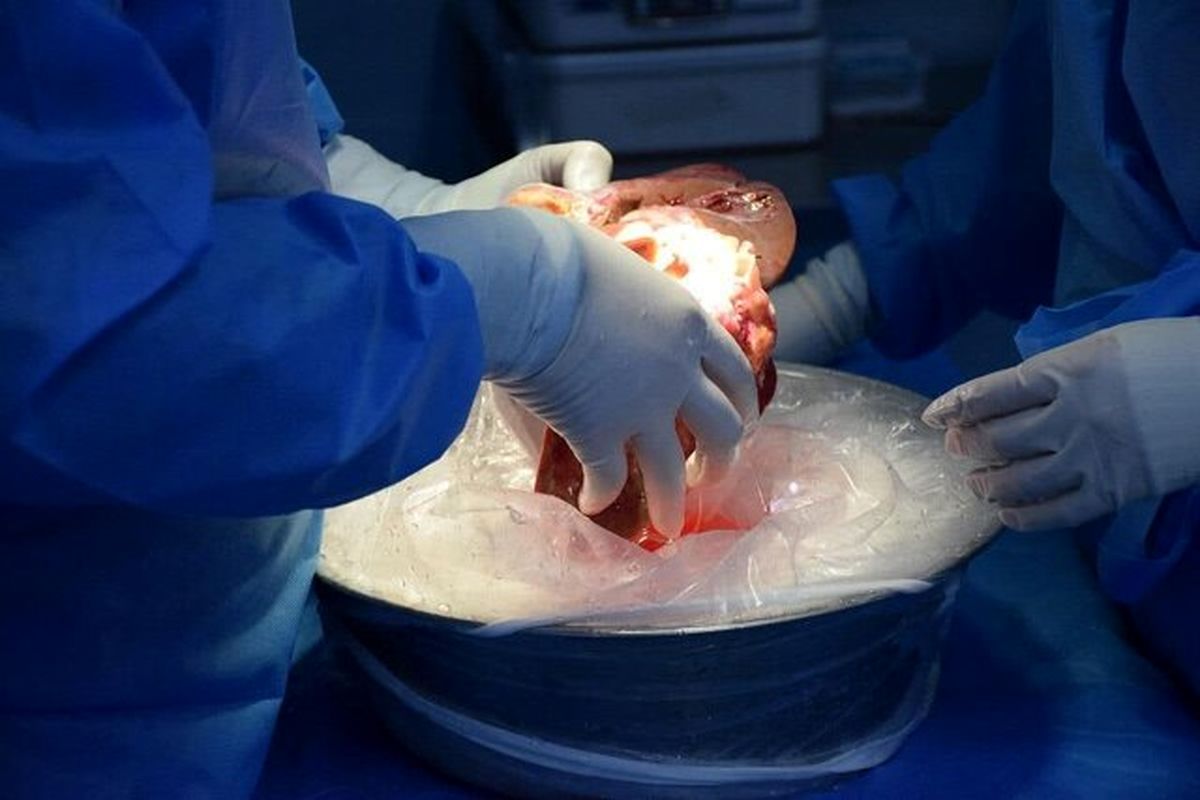 پیوند کبد تبریز