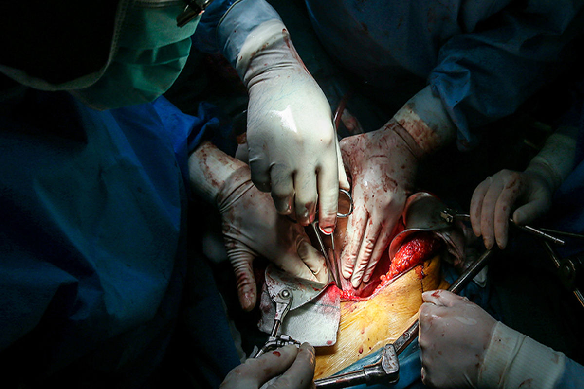 پیوند موفقیت آمیز کبد در شمال کشور