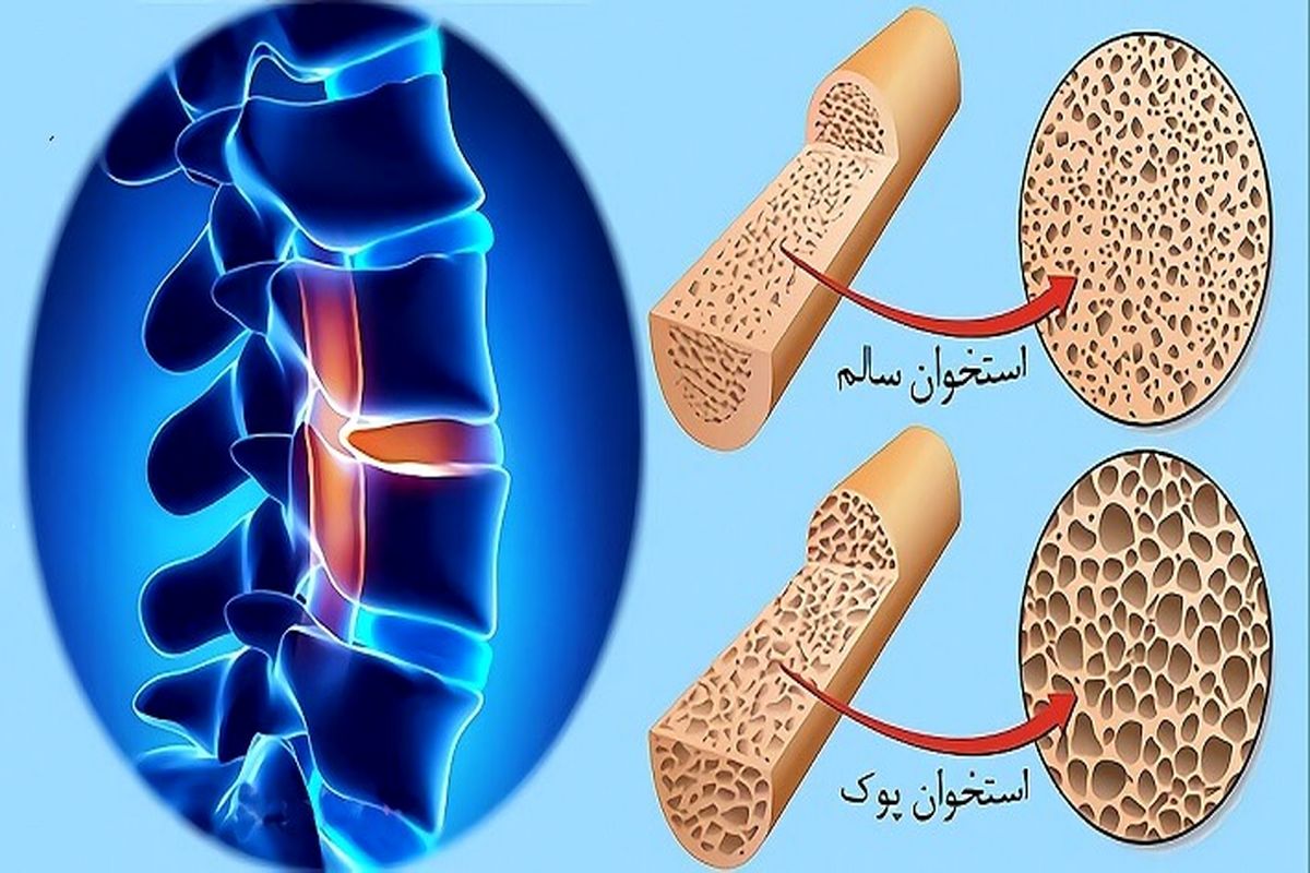 پوکی استخوان 