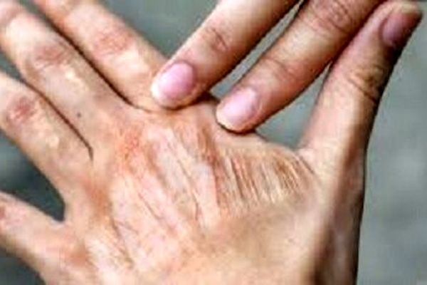 آلودگی هوا بر سلامت و پیری پوست تأثیر خاموش دارد