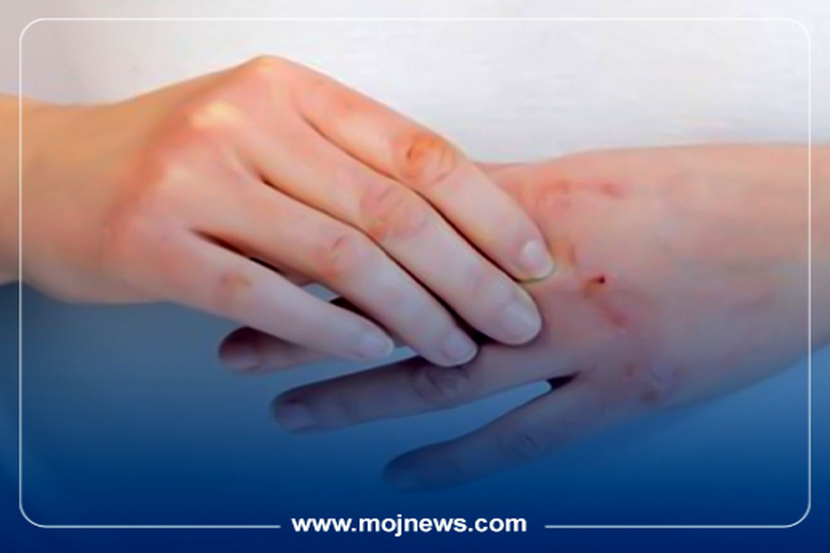 کاور پوست و زمستان