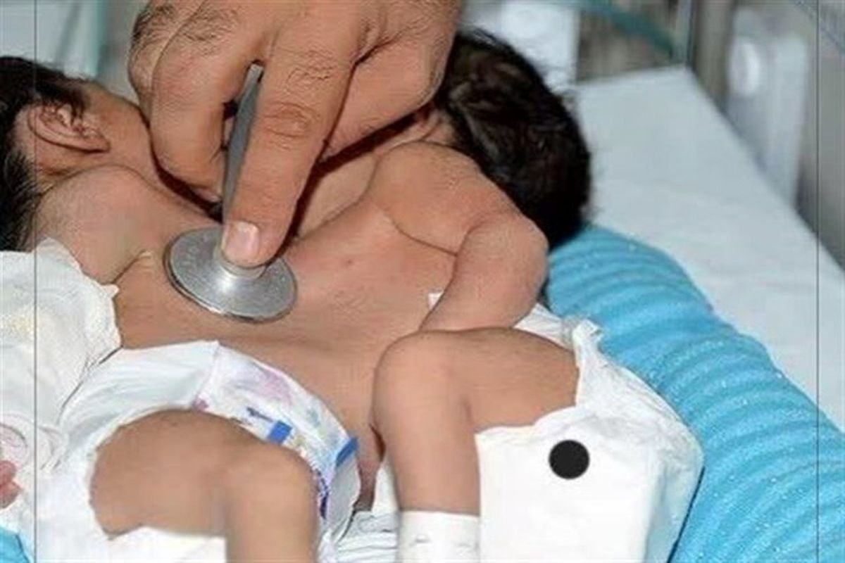 جداسازی دوقلوهای اهوازی 