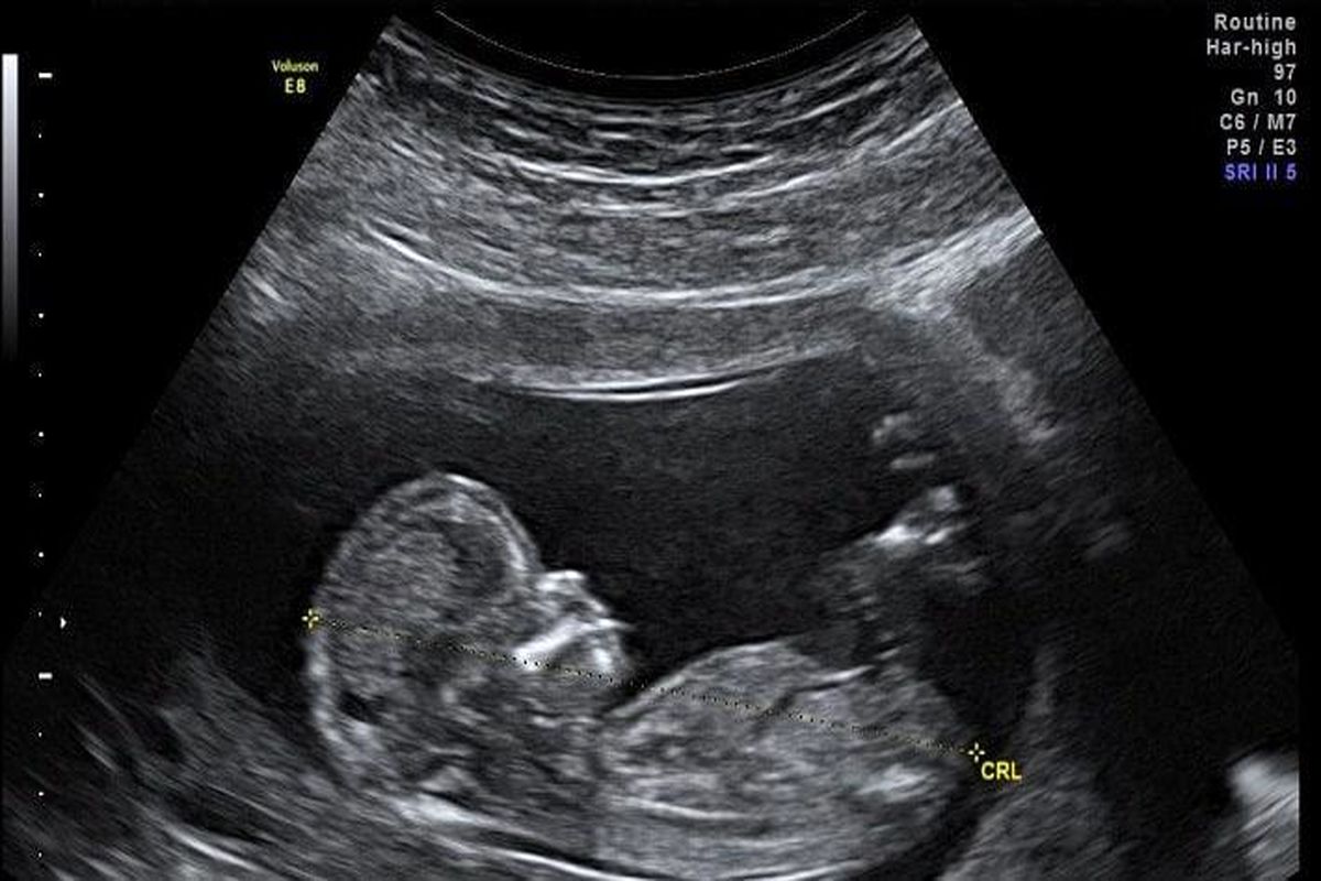 کیت‌های استاندارد غربالگری