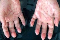 مورد جدید سویه Ib آبله میمون در بریتانیا دیده شد