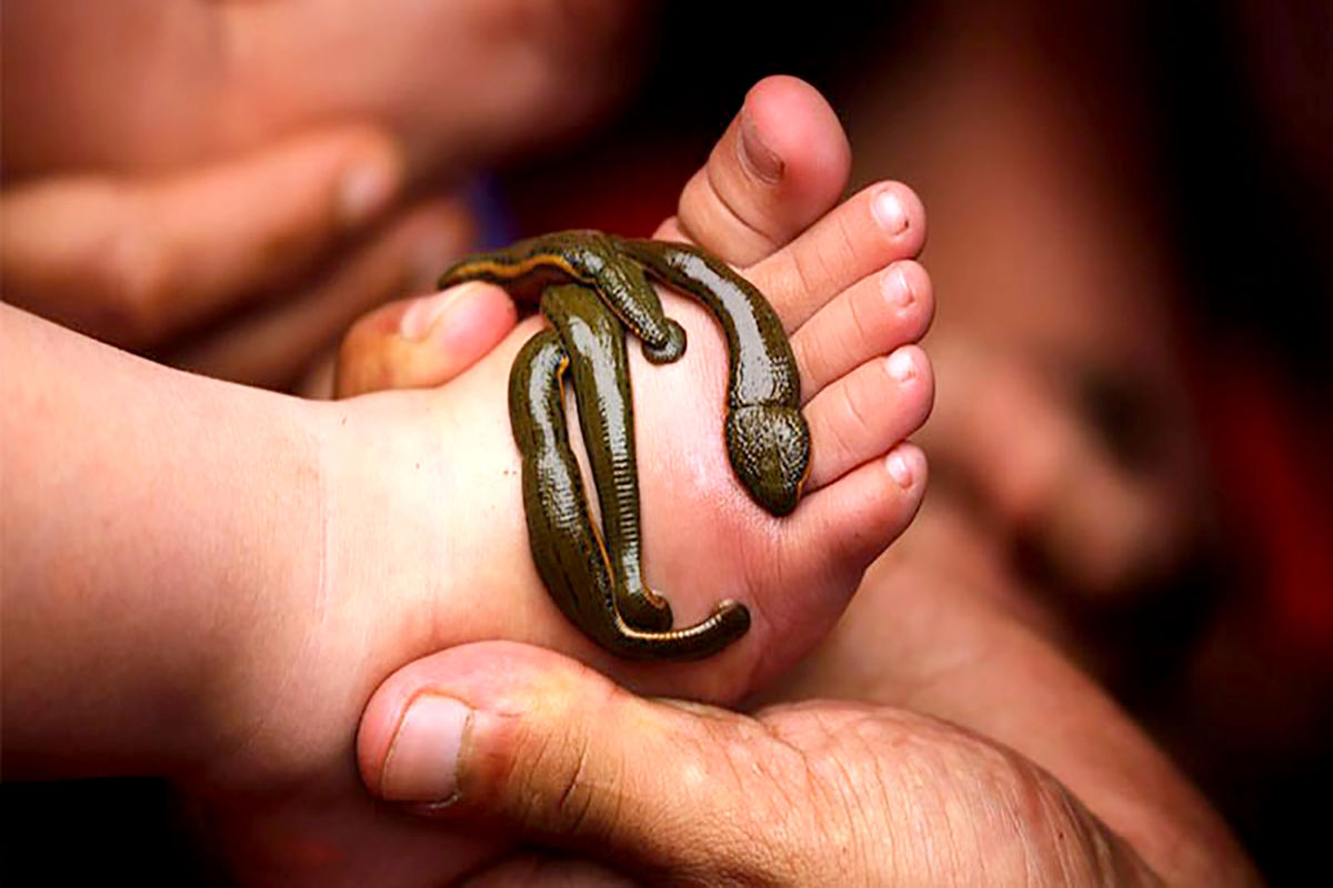  زالو درمانی