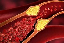 گرفتگی عروق قلب را چگونه با طب سنتی درمان کنیم؟
