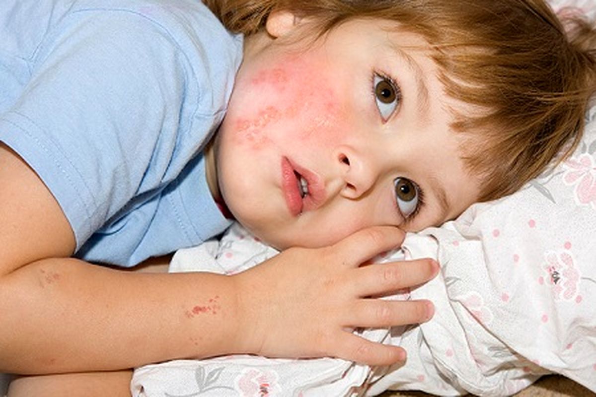 بیماری زونا