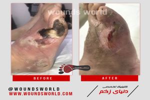 درمان زخم دیابتی چیست و چگونه درمان میشود ؟