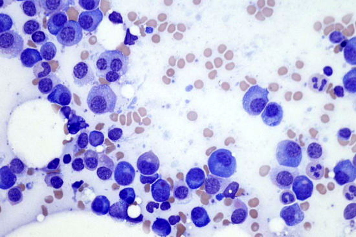 تومور سرطانی