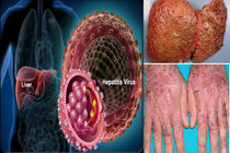 انتقال مادر به نوزاد بیشترین راه آلودگی به هپاتیت نوع B در کشور است/ بیشتر مبتلایان به هپاتیت از بیماری خود بی اطلاعند