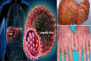 انتقال مادر به نوزاد بیشترین راه آلودگی به هپاتیت نوع B در کشور است/ بیشتر مبتلایان به هپاتیت از بیماری خود بی اطلاعند