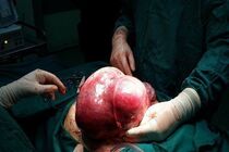 خارج شدن توده پنج کیلویی از شکم دختر ۱۳ ساله در کرمانشاه
