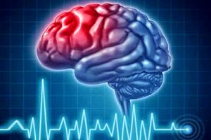  سه ماهه ابتدایی پس از سکته مغزی، زمان طلایی بازتوانی بیمار است