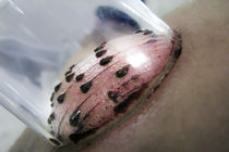 بهترین زمان برای حجامت / نخستین و آخرین مرحله درمان در طب سنتی را بشناسید